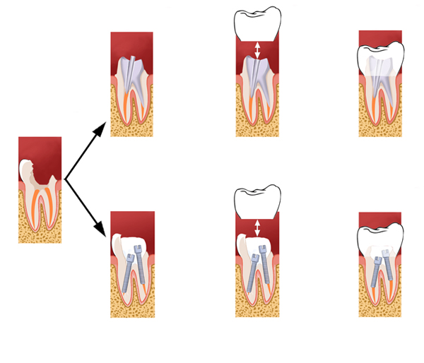 Pose d'implants et de facettes dentaires à Toulouse